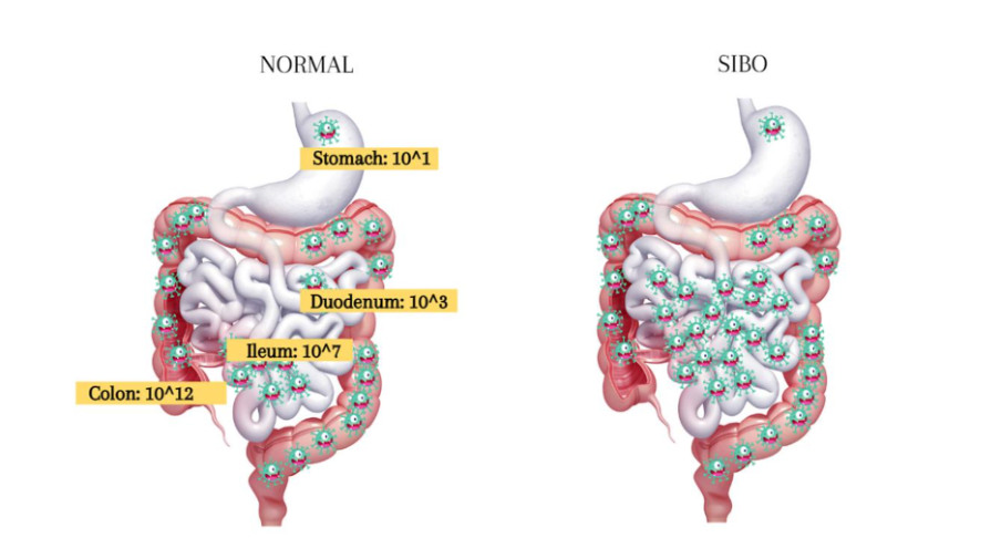 Normal vs SIBO gut bacteria